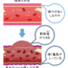 高血圧 原因のイメージ：塩分と血管ダメージ