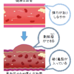 高血圧 原因のイメージ：塩分と血管ダメージ